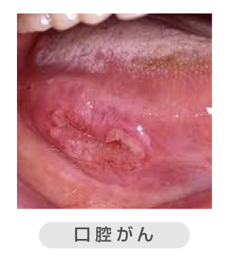 口腔粘膜疾患02